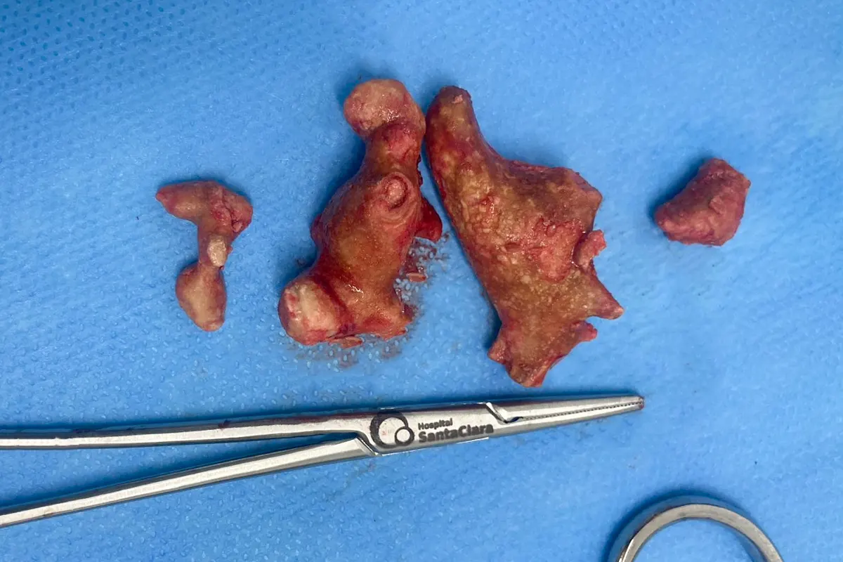 Cálculos renais de grande porte