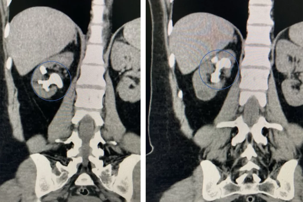 Tomografia computadorizada identifica cálculos renais grandes