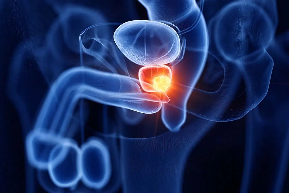 Câncer de próstata