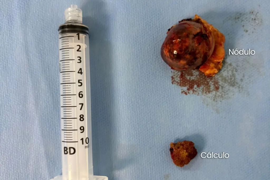 Nódulo e cálculo renais em comparação com uma seringa