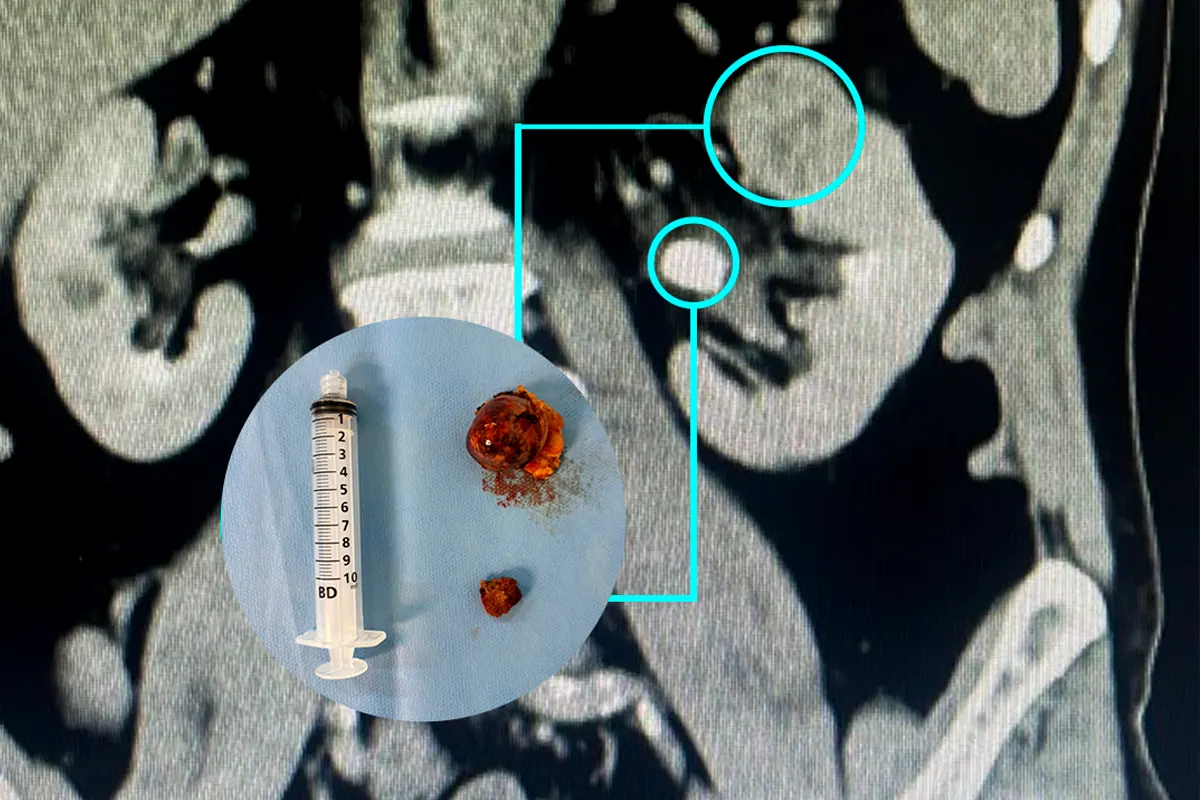 Caso cirúrgico: Nefrectomia Parcial e Pielolitotomia Robótica