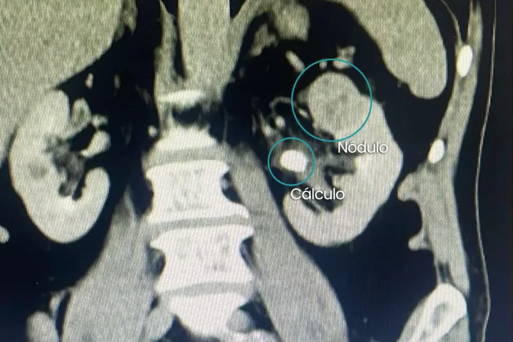 Paciente ICR.T - tomografia com cálculo e nódulo
